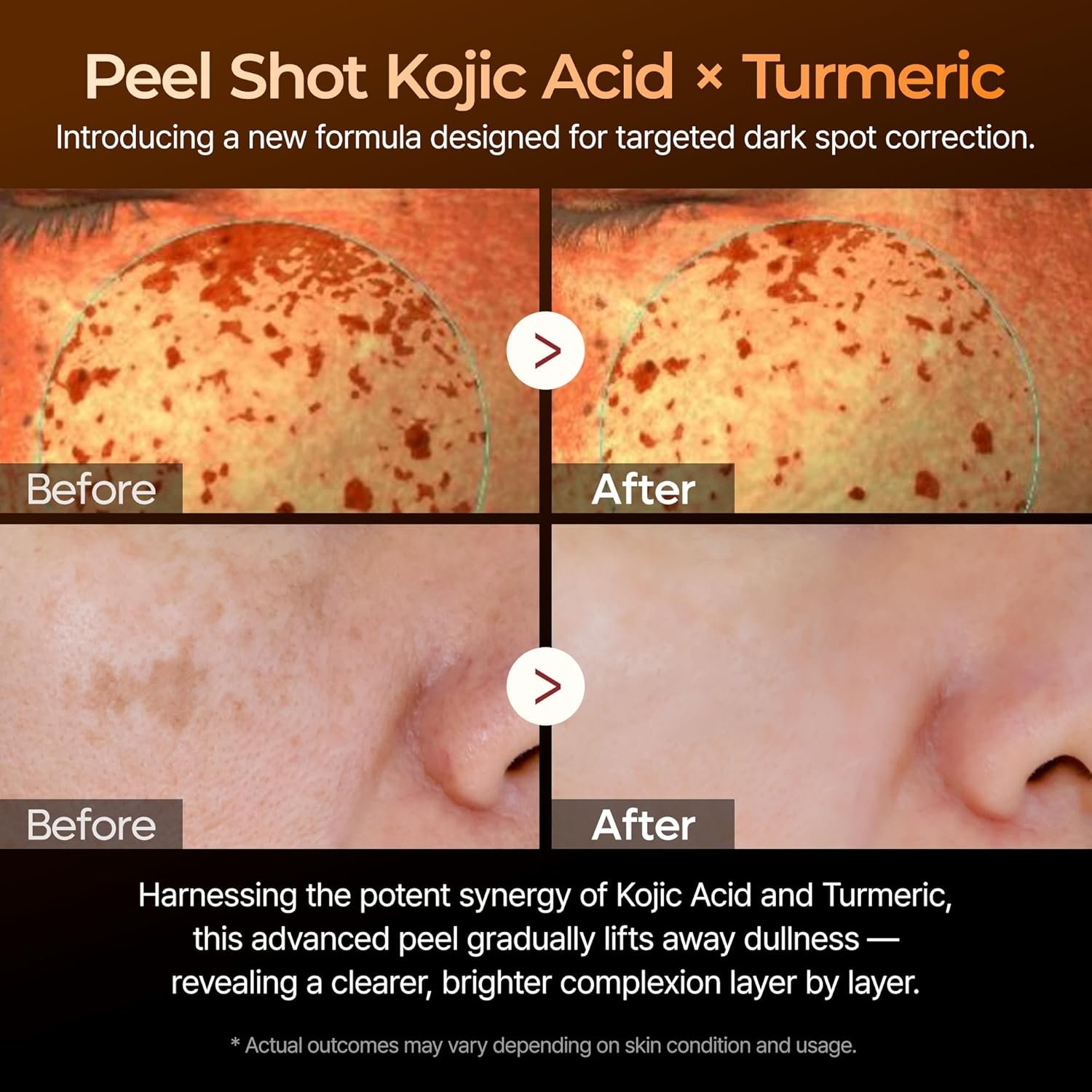 Dr.Melaxin Peel Shot Kojic Acid Turmeric Serum – Exfoliating Dark Spot Corrector with AHA/BHA & Niacinamide, Brightening & Even Tone Facial Serum (80ml / 2.70 fl oz)