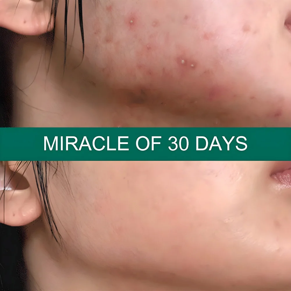 كريم سوبر المعجزة لعلاج البقع الداكنة من سوم باي مي 30 مل – Some by Mi Super Miracle Cream for Dark Spots 30ml