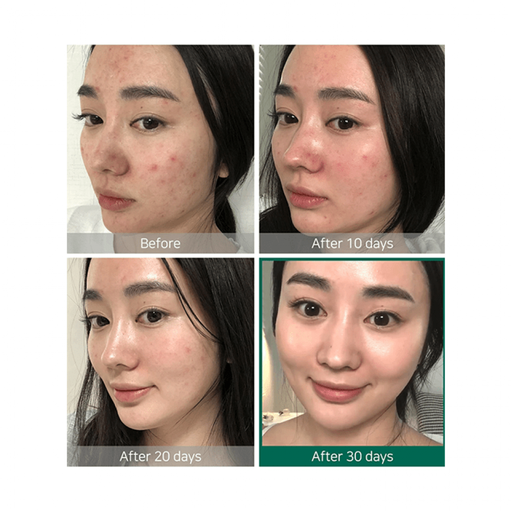 تونر المعجزة AHA BHA PHA من سوم باي مي 150مل – Some By Mi AHA BHA PHA 30 Days Miracle Toner 150ml