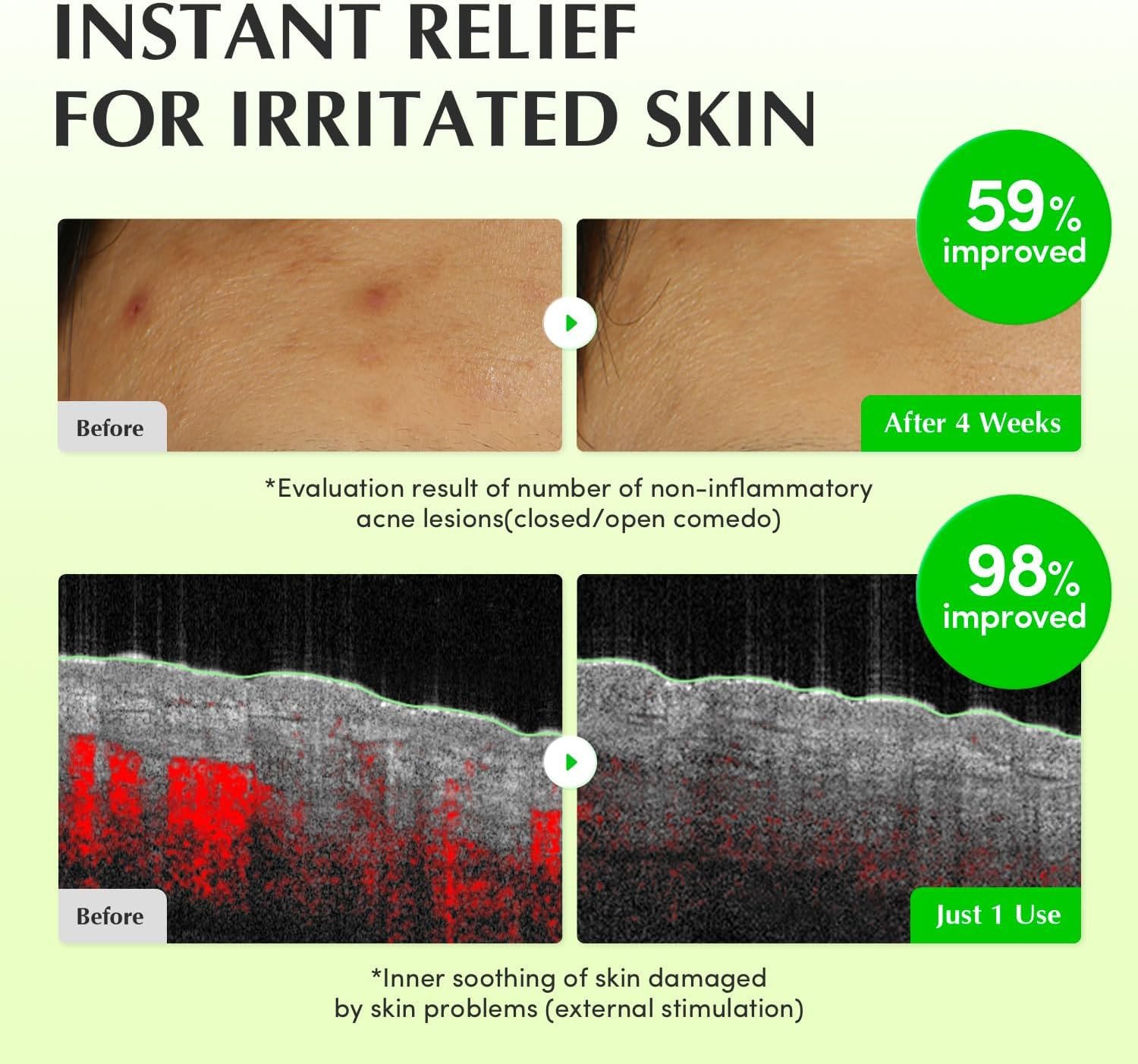 EQQUALBERRY Aloe PDRN Calming Toner, for Sensitive, | Instant Relief & Cooling | Non-Comedogenic & Fungal Acne Safe, Skin Barrier Repair | K-Beauty (5.07 fl.oz / 150ml)