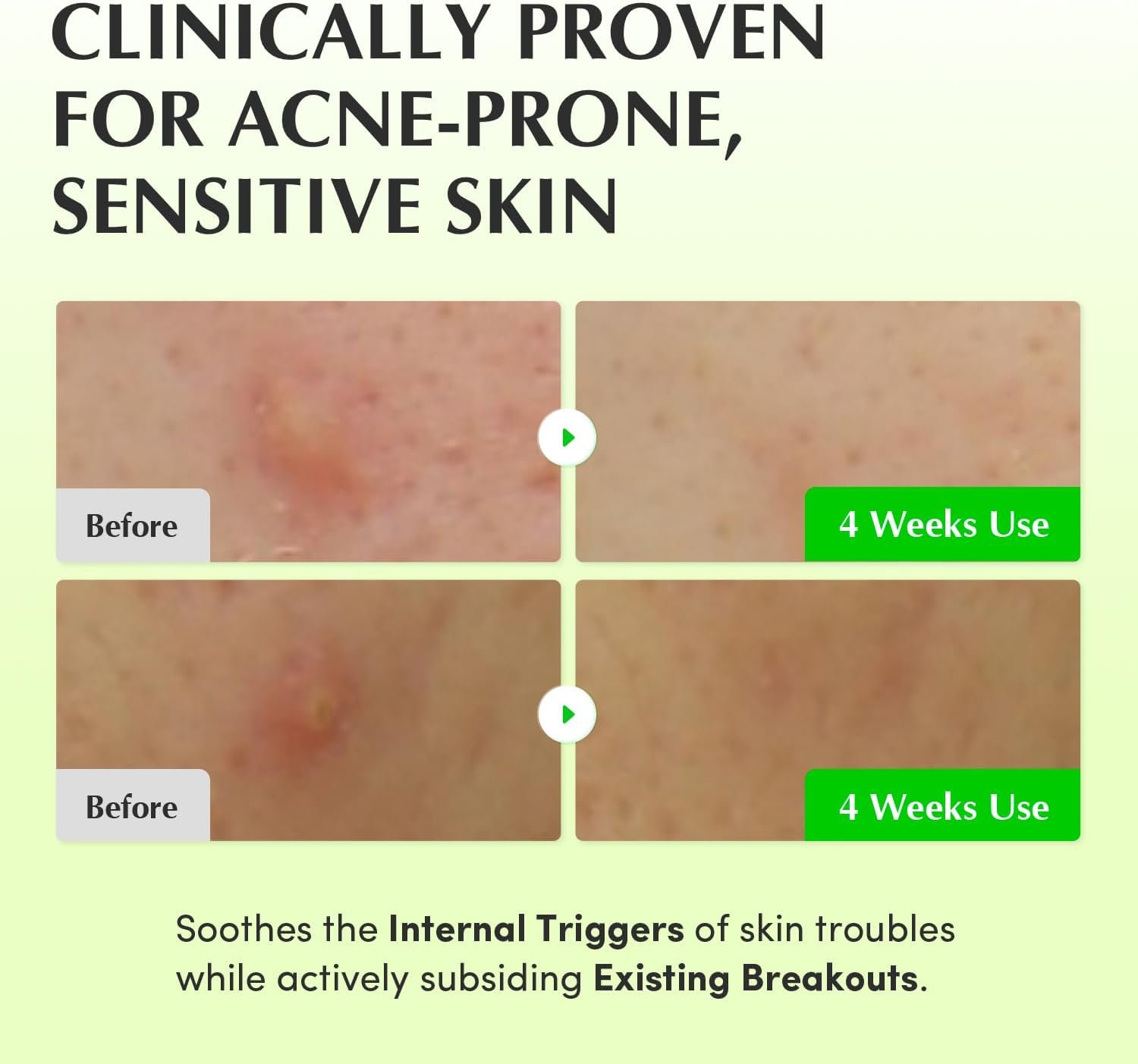 EQQUALBERRY Aloe PDRN Calming Toner, for Sensitive, | Instant Relief & Cooling | Non-Comedogenic & Fungal Acne Safe, Skin Barrier Repair | K-Beauty (5.07 fl.oz / 150ml)