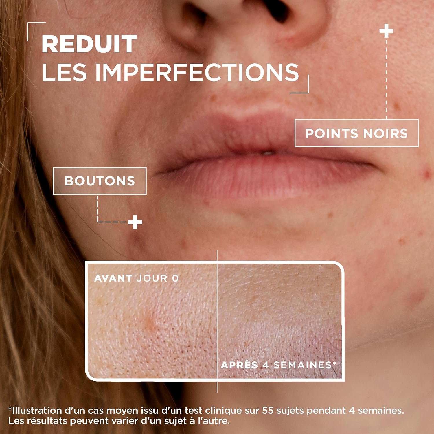 Mixa Anti-Imperfection Serum with Salicylic Acid and Niacinamide, Sensitive Skin 30 ml